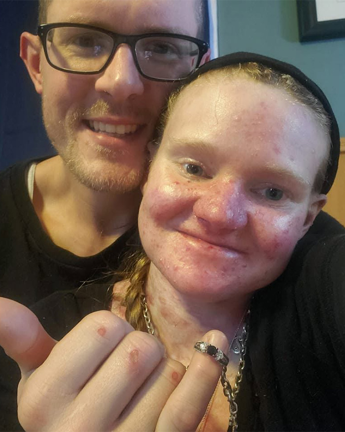 Woman With One Of The World’s Rarest Skin Conditions Details Extreme Measures To Protect Herself Woman With One Of The World’s Rarest Skin Conditions Details Extreme Measures To Protect Herself
