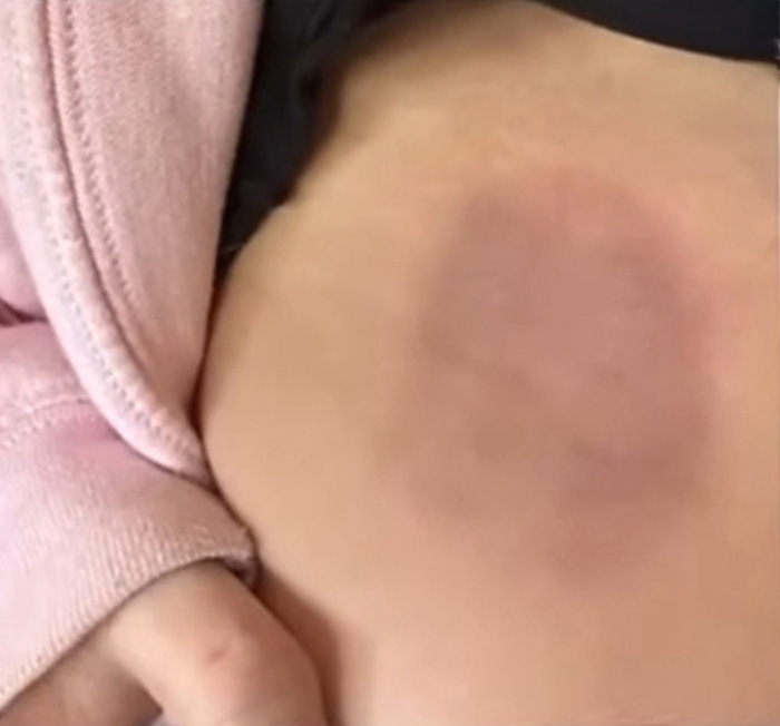 Karma Strikes As 13-Year-Old Faces Charges After Dodgeball Incident Leaves Ex-Girlfriend Hospitalized Karma Strikes As 13-Year-Old Faces Charges After Dodgeball Incident Leaves Ex-Girlfriend Hospitalized