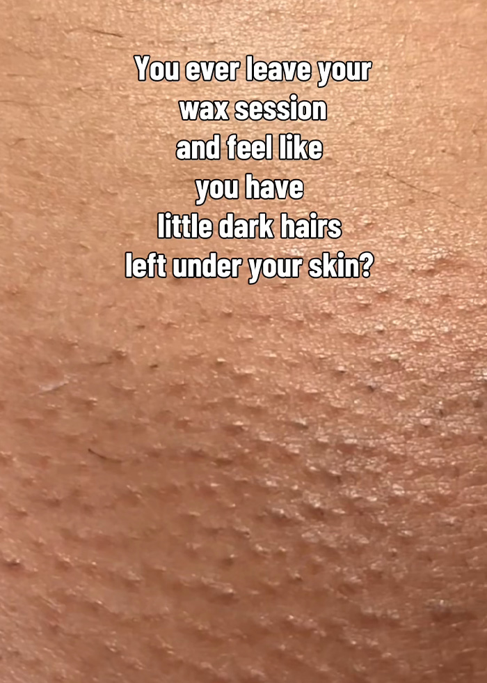 Brazilian Wax Client Goes Viral After Revealing The Embarrassing Side Effect Salons Fail To Mention And The Chilling Name For It Brazilian Wax Client Goes Viral After Revealing The Embarrassing Side Effect Salons Fail To Mention And The Chilling Name For It