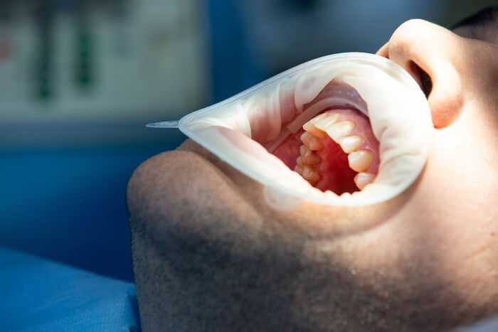 150 Patients Share The Medical Procedures That Hurt Far More Than Doctors Had Led Them To Expect