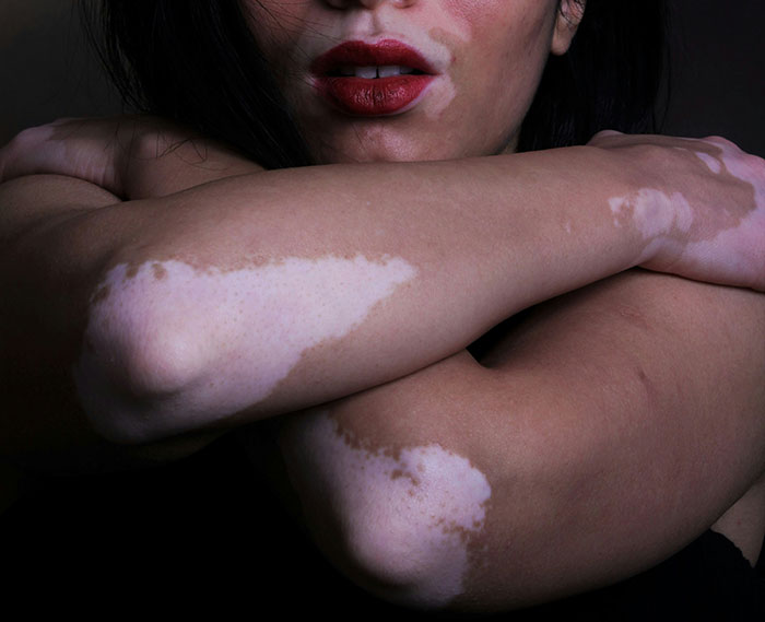 Guy’s Mom Makes His GF’s Vitiligo Her Favorite Insult, Stops Laughing When She Develops It Herself Guy’s Mom Makes His GF’s Vitiligo Her Favorite Insult, Stops Laughing When She Develops It Herself