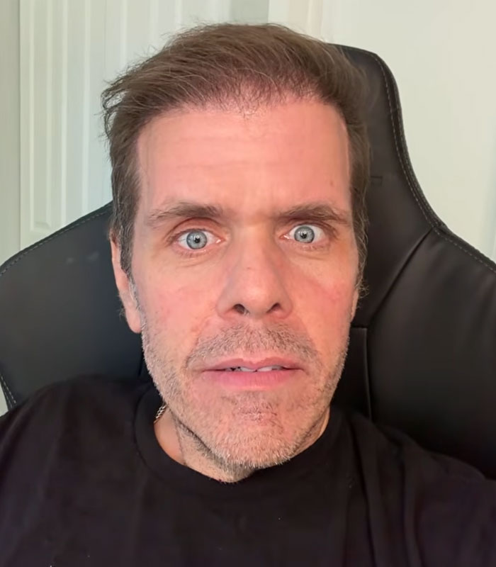 Perez Hilton Faces Permanent “Disfigurement” As New Details Emerge About His Recovery After Disturbing Livestream Perez Hilton Faces Permanent “Disfigurement” As New Details Emerge About His Recovery After Disturbing Livestream