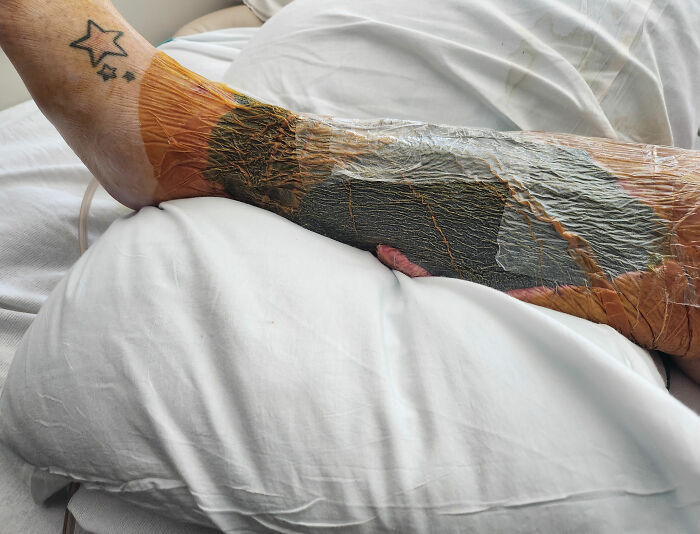 Woman Who Lost ‘A Lot Of My Leg’ To Flesh-Eating Bacteria Warns Women About Common Pre-Swim Habit Woman Who Lost ‘A Lot Of My Leg’ To Flesh-Eating Bacteria Warns Women About Common Pre-Swim Habit