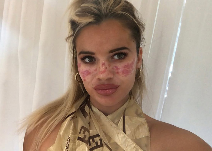 Reality Star Launches Fake Freckle Brand After Attempt At Tattooing Her Own Face For Viral Trend Left Her Scarred