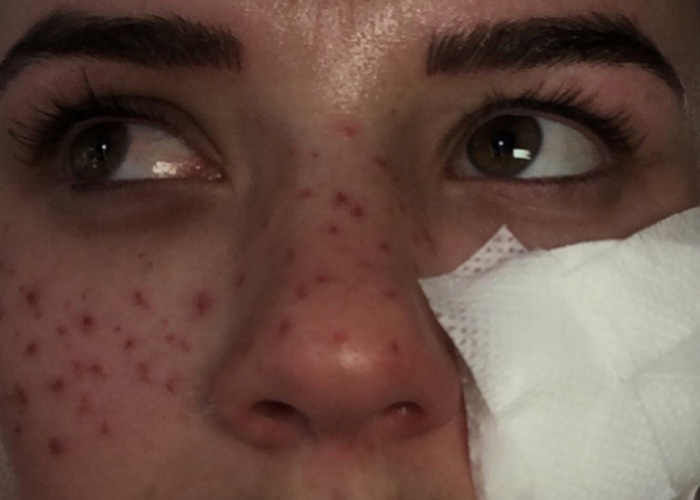 Reality Star Launches Fake Freckle Brand After Attempt At Tattooing Her Own Face For Viral Trend Left Her Scarred