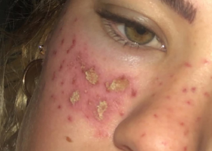Reality Star Launches Fake Freckle Brand After Attempt At Tattooing Her Own Face For Viral Trend Left Her Scarred