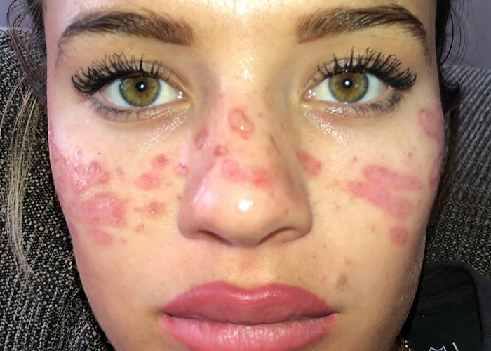 Reality Star Launches Fake Freckle Brand After Attempt At Tattooing Her Own Face For Viral Trend Left Her Scarred