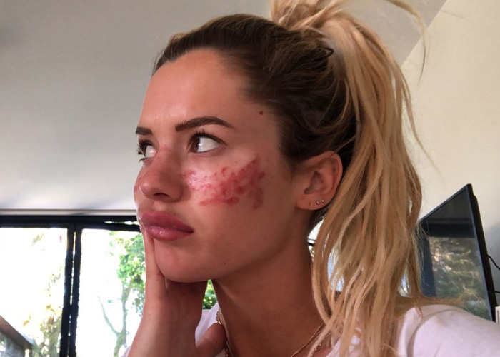 Reality Star Launches Fake Freckle Brand After Attempt At Tattooing Her Own Face For Viral Trend Left Her Scarred