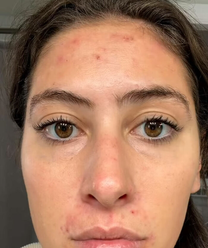 Expert Chimes In After Woman Claims Her Before-And-After Pics Of Trip To France “Prove” The US Diet Keeps People “Chronically Inflamed” Expert Chimes In After Woman Claims Her Before-And-After Pics Of Trip To France “Prove” The US Diet Keeps People “Chronically Inflamed”