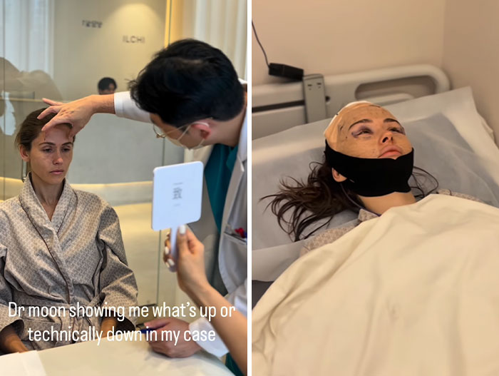 How Young Is Too Young To Get A Korean Facelift? Netizens Criticize Influencer’s Decision After Recovery Posts How Young Is Too Young To Get A Korean Facelift? Netizens Criticize Influencer’s Decision After Recovery Posts