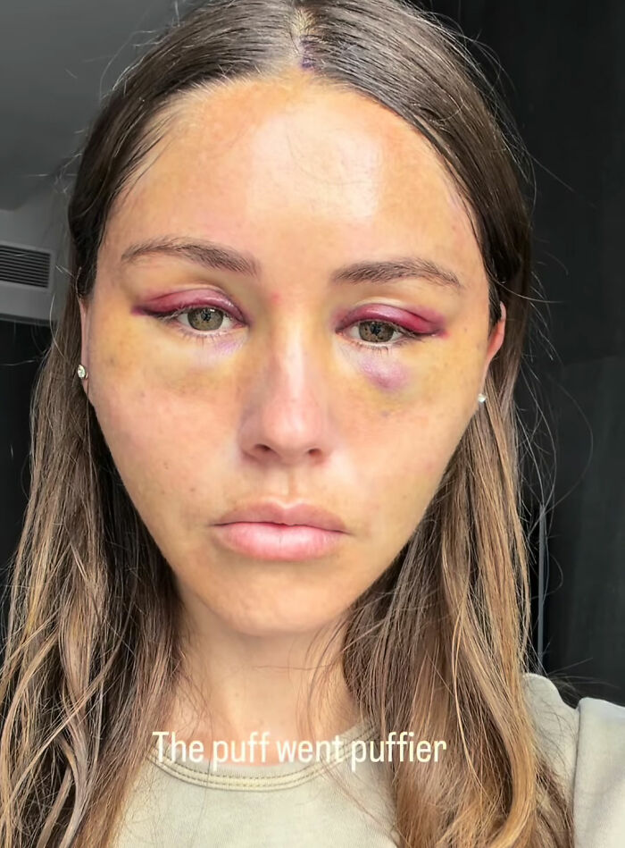 How Young Is Too Young To Get A Korean Facelift? Netizens Criticize Influencer’s Decision After Recovery Posts How Young Is Too Young To Get A Korean Facelift? Netizens Criticize Influencer’s Decision After Recovery Posts