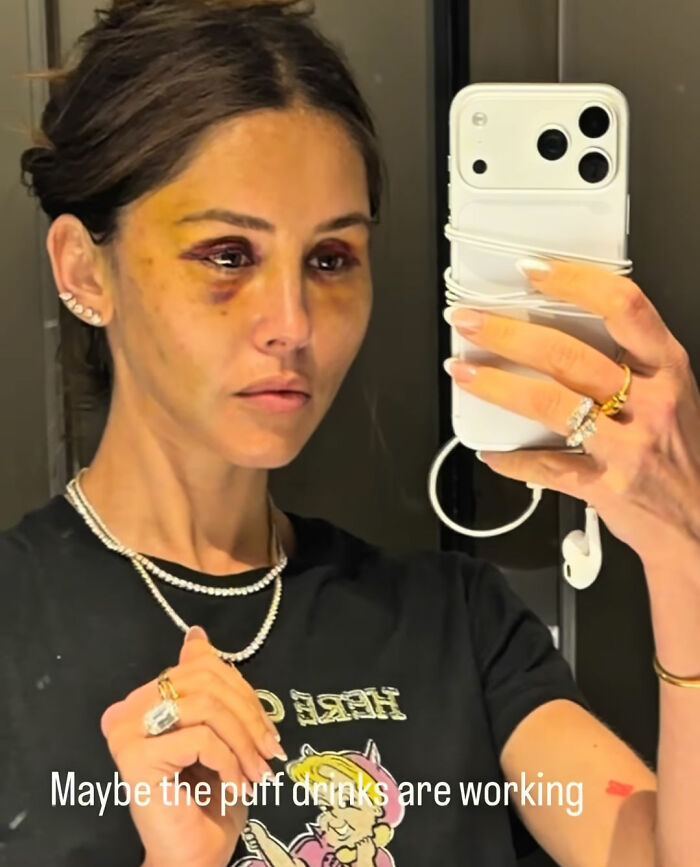 How Young Is Too Young To Get A Korean Facelift? Netizens Criticize Influencer’s Decision After Recovery Posts How Young Is Too Young To Get A Korean Facelift? Netizens Criticize Influencer’s Decision After Recovery Posts