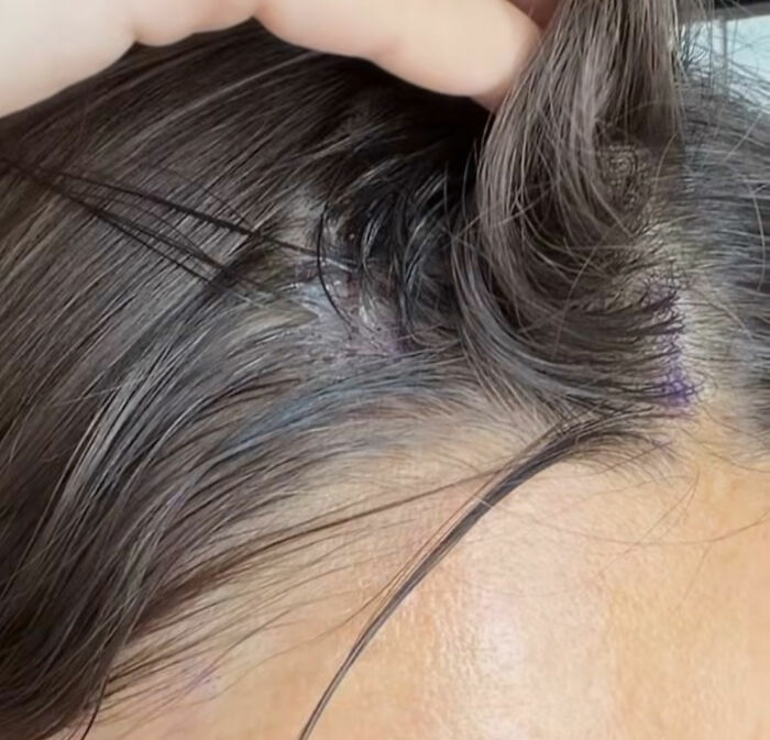 How Young Is Too Young To Get A Korean Facelift? Netizens Criticize Influencer’s Decision After Recovery Posts How Young Is Too Young To Get A Korean Facelift? Netizens Criticize Influencer’s Decision After Recovery Posts