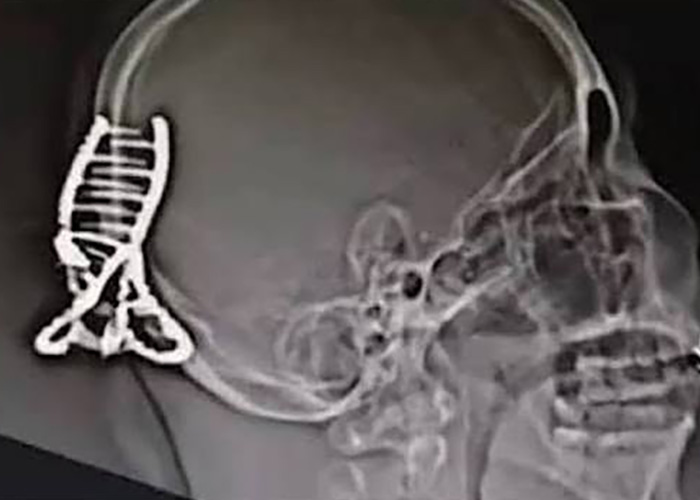 Doctors Reveal Scary Reality About Hair Accessory That Can Cause Life Threatening Injures Doctors Reveal Scary Reality About Hair Accessory That Can Cause Life Threatening Injures