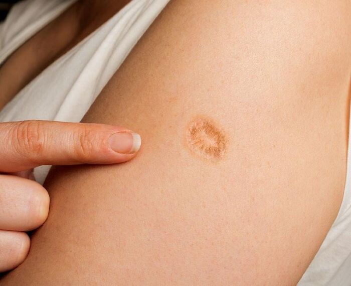 Lots Of People Have This Circular Scar, And Some Are Only Just Finding Out The Reason Behind It