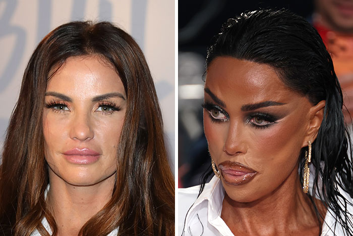 Katie Price Sparks Concern With Latest Appearance After Having Corrective Surgery Katie Price Sparks Concern With Latest Appearance After Having Corrective Surgery