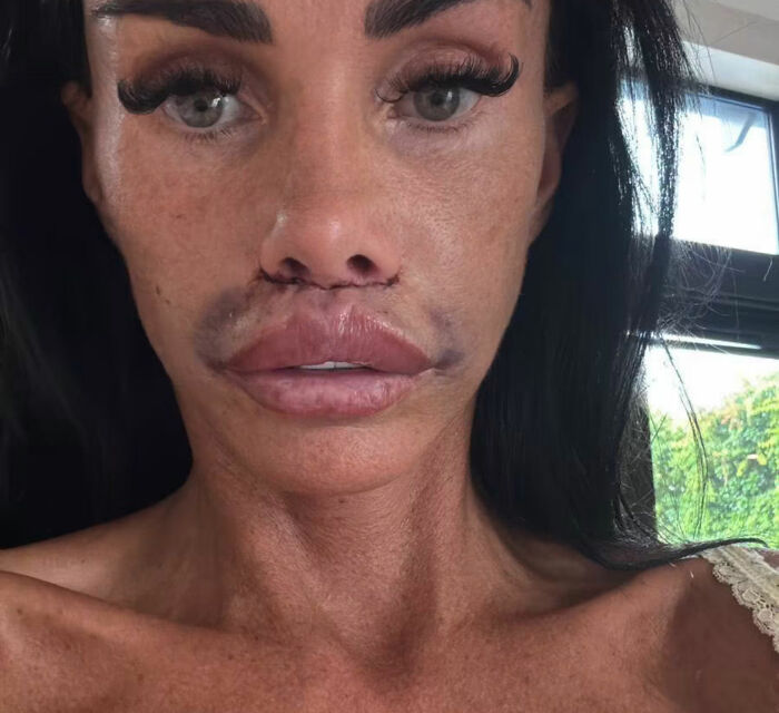 Katie Price Sparks Concern With Latest Appearance After Having Corrective Surgery Katie Price Sparks Concern With Latest Appearance After Having Corrective Surgery