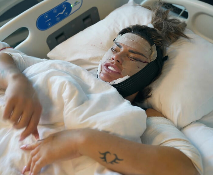 Katie Price Sparks Concern With Latest Appearance After Having Corrective Surgery Katie Price Sparks Concern With Latest Appearance After Having Corrective Surgery
