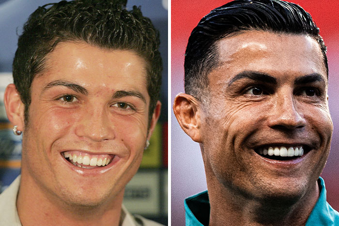 10 Famous People Who “Looksmaxxed” Throughout The Years, As Plastic Surgeons Hint At Procedures 10 Famous People Who “Looksmaxxed” Throughout The Years, As Plastic Surgeons Hint At Procedures