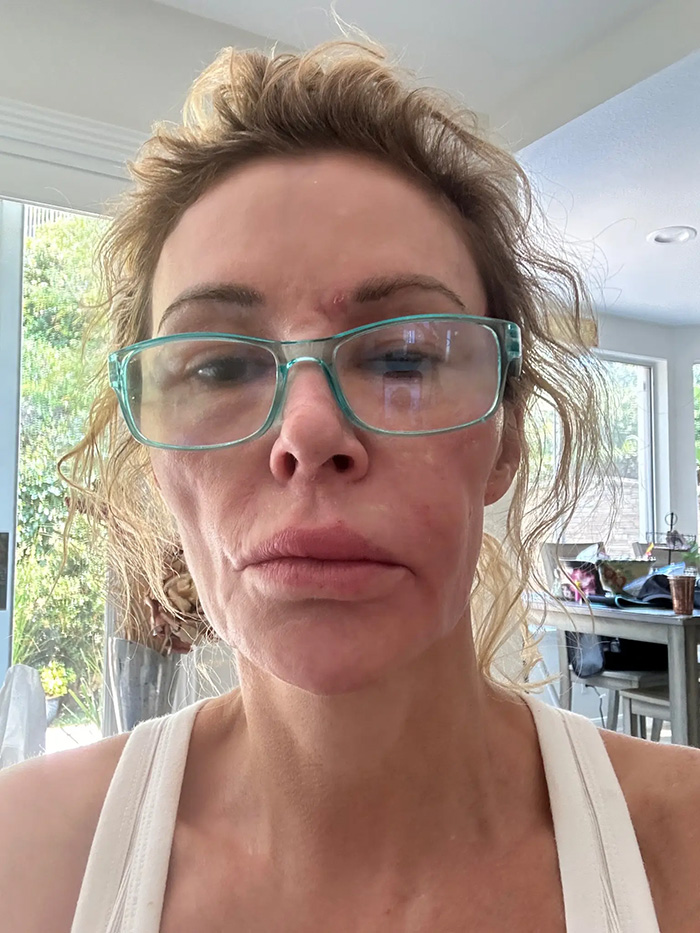 &lsquo;Embarrassed&rsquo; Brandi Glanville Breaks Down Over Asking Fans For Money Amid Ongoing Facial Disfigurement