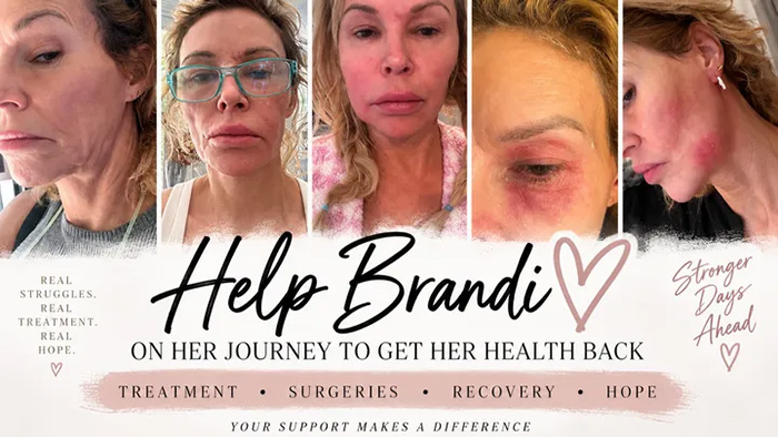 &lsquo;Embarrassed&rsquo; Brandi Glanville Breaks Down Over Asking Fans For Money Amid Ongoing Facial Disfigurement