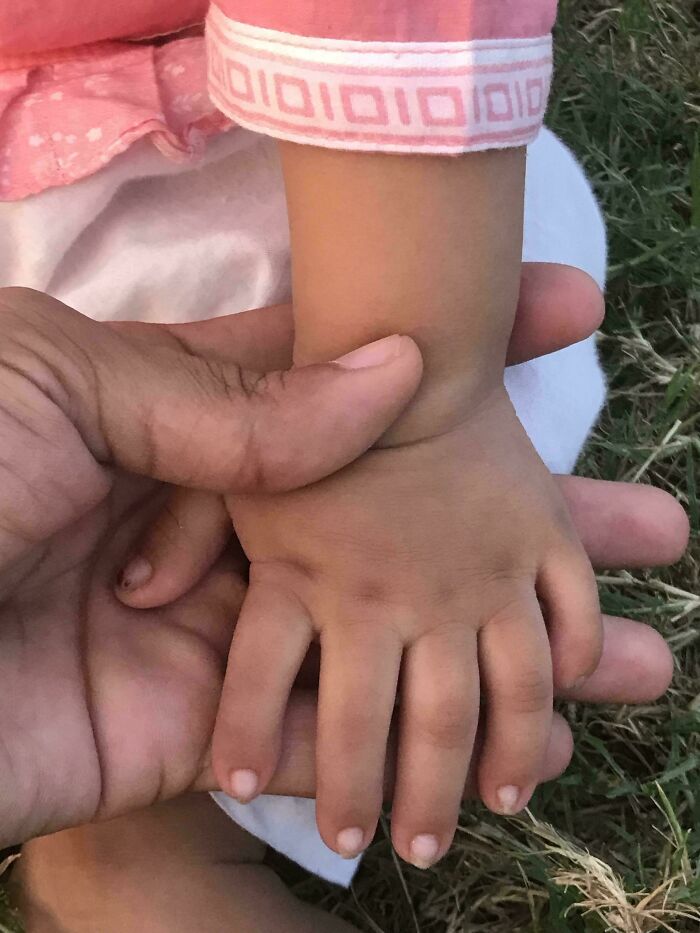&ldquo;40 Years Of Hiding These&rdquo;: 85 Rare And Unexpected Body Quirks That Left People Fascinated