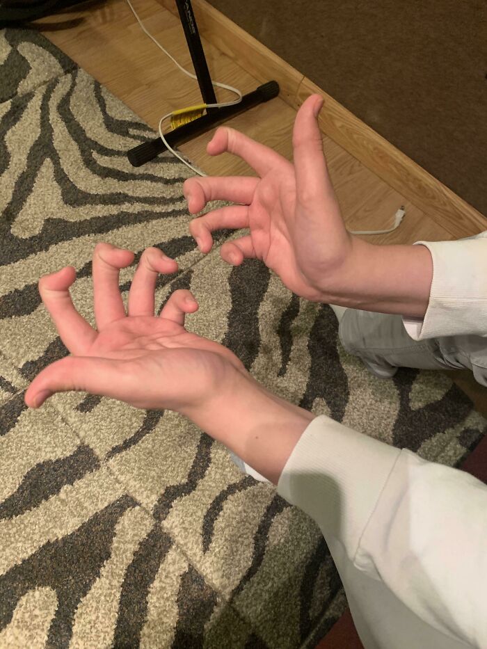 &ldquo;40 Years Of Hiding These&rdquo;: 85 Rare And Unexpected Body Quirks That Left People Fascinated