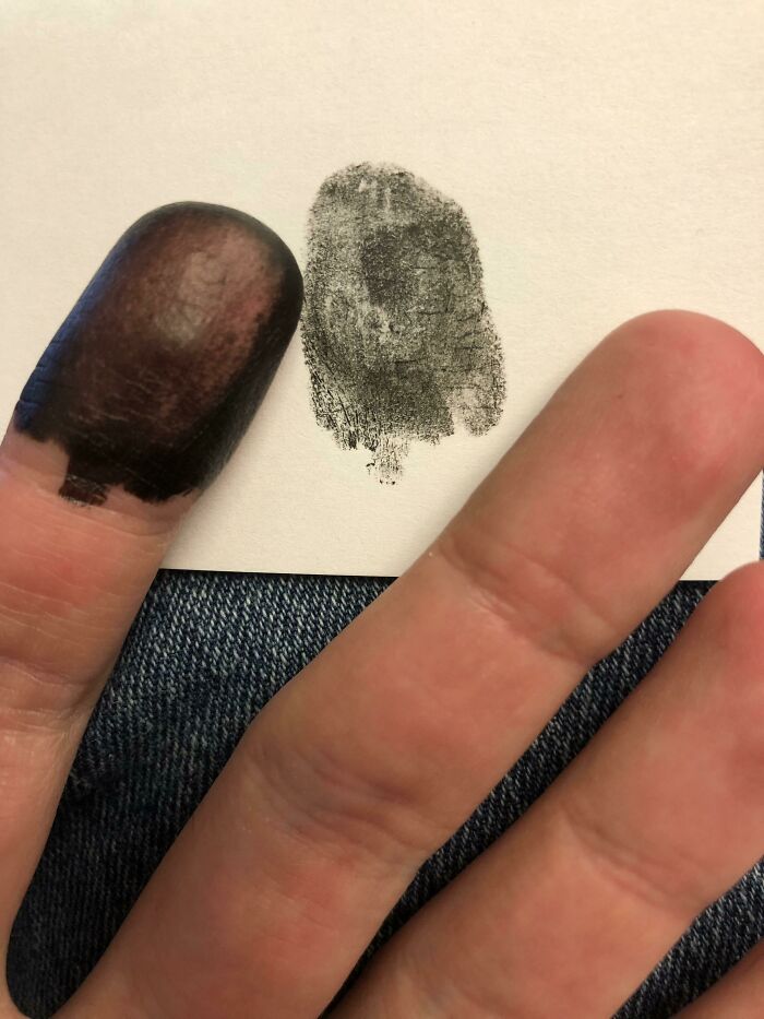 &ldquo;40 Years Of Hiding These&rdquo;: 85 Rare And Unexpected Body Quirks That Left People Fascinated