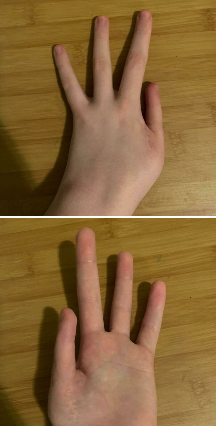 &ldquo;40 Years Of Hiding These&rdquo;: 85 Rare And Unexpected Body Quirks That Left People Fascinated