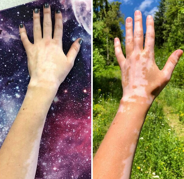 &ldquo;40 Years Of Hiding These&rdquo;: 85 Rare And Unexpected Body Quirks That Left People Fascinated