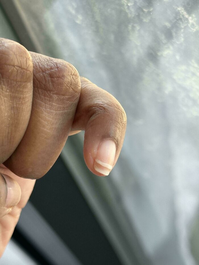 &ldquo;40 Years Of Hiding These&rdquo;: 85 Rare And Unexpected Body Quirks That Left People Fascinated
