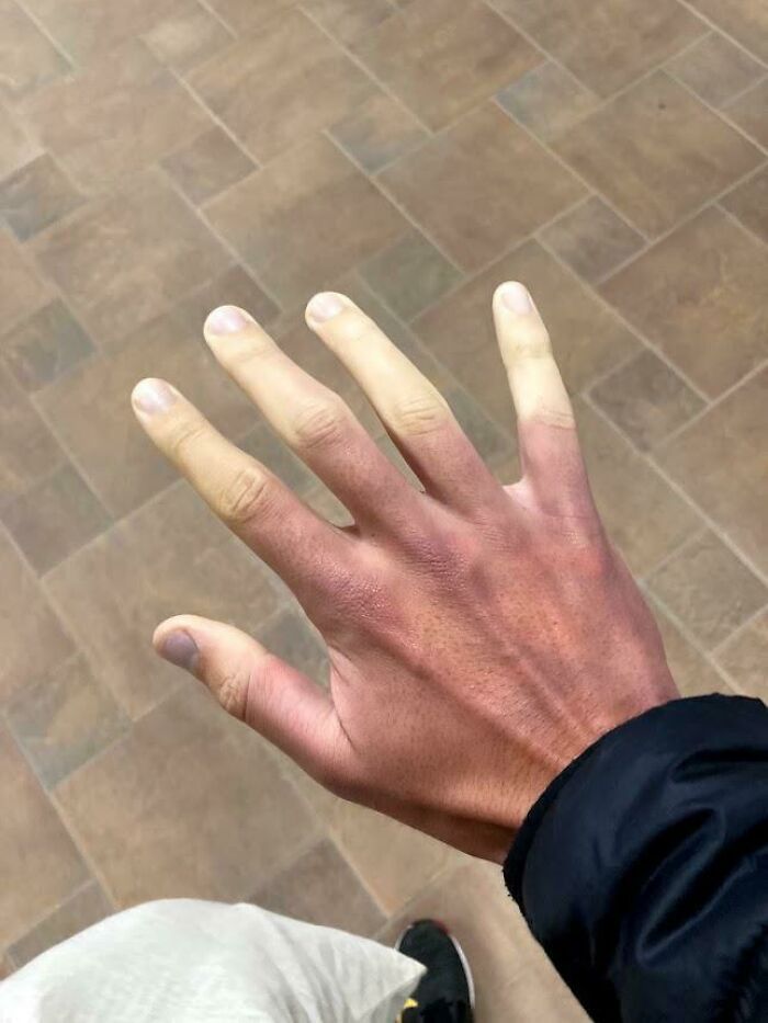 &ldquo;40 Years Of Hiding These&rdquo;: 85 Rare And Unexpected Body Quirks That Left People Fascinated