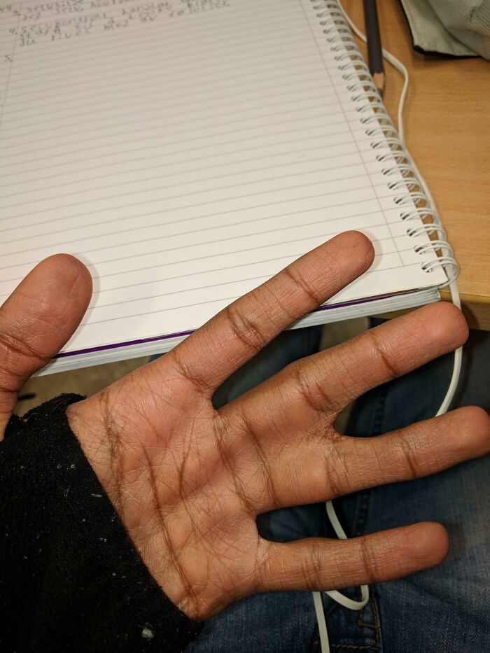 &ldquo;40 Years Of Hiding These&rdquo;: 85 Rare And Unexpected Body Quirks That Left People Fascinated