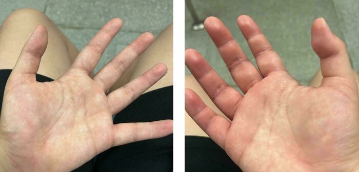 &ldquo;40 Years Of Hiding These&rdquo;: 85 Rare And Unexpected Body Quirks That Left People Fascinated