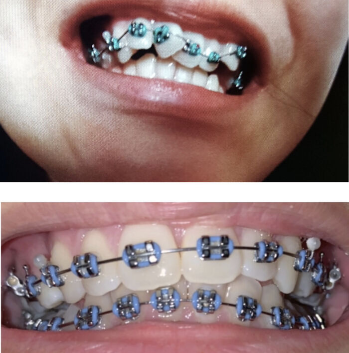 66 Before And After Photos That Show Surprising, Fascinating And Inspiring Transformations