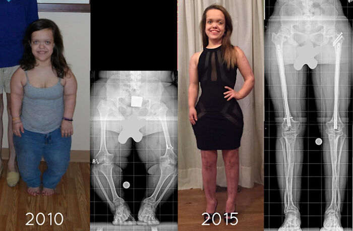 66 Before And After Photos That Show Surprising, Fascinating And Inspiring Transformations