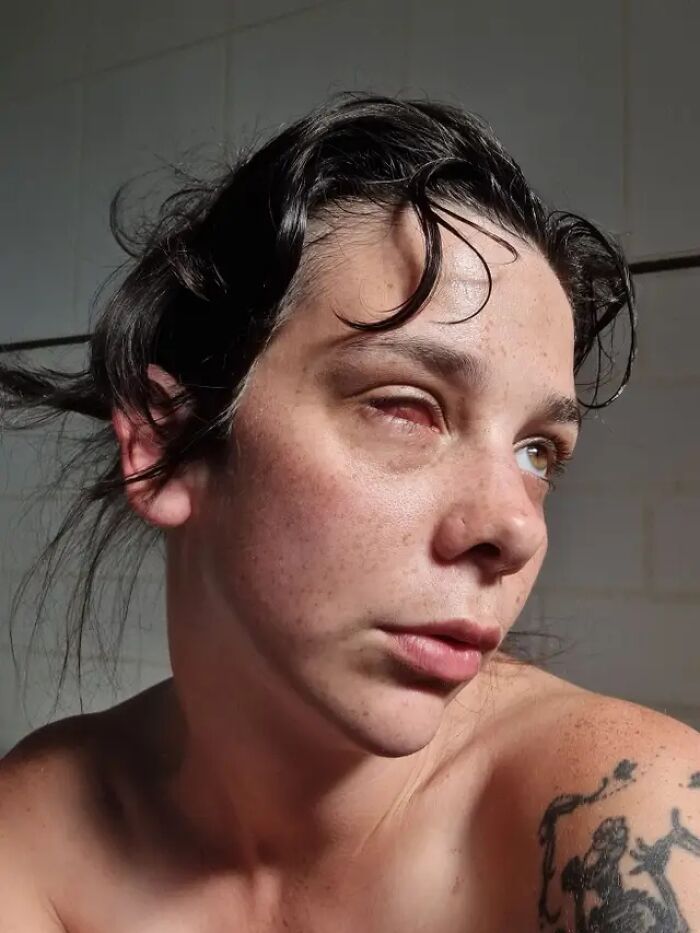 Woman Thinks Her Blurry Vision Is Just A Hangover, Ends Up Losing Her Eye After Doctors Find A Tumor Woman Thinks Her Blurry Vision Is Just A Hangover, Ends Up Losing Her Eye After Doctors Find A Tumor