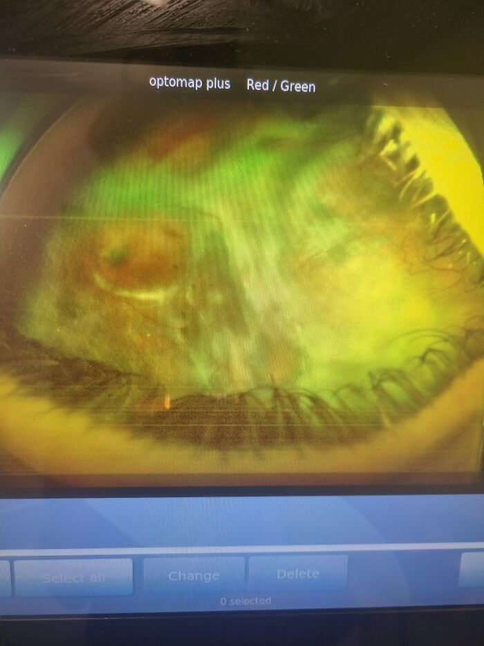 Woman Thinks Her Blurry Vision Is Just A Hangover, Ends Up Losing Her Eye After Doctors Find A Tumor Woman Thinks Her Blurry Vision Is Just A Hangover, Ends Up Losing Her Eye After Doctors Find A Tumor