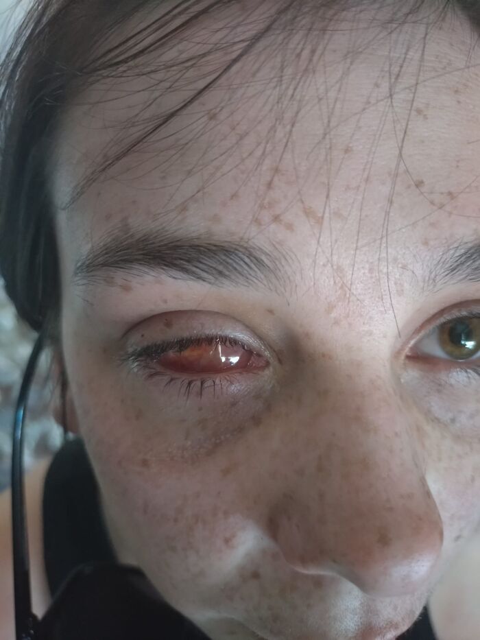 Woman Thinks Her Blurry Vision Is Just A Hangover, Ends Up Losing Her Eye After Doctors Find A Tumor Woman Thinks Her Blurry Vision Is Just A Hangover, Ends Up Losing Her Eye After Doctors Find A Tumor