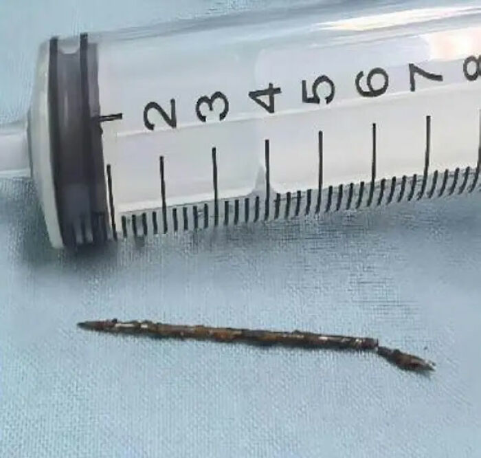 Doctors Make Damning Discovery Of ‘Foreign Bodies’ In Man’s Chest, Pelvis, Bladder And Private Parts At Chinese Hospital