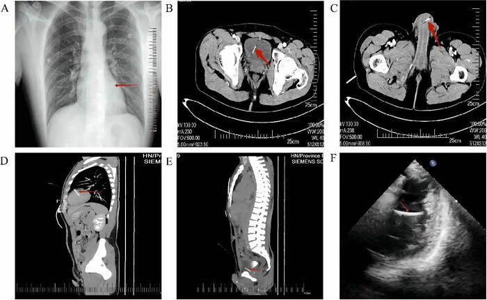 Doctors Make Damning Discovery Of ‘Foreign Bodies’ In Man’s Chest, Pelvis, Bladder And Private Parts At Chinese Hospital