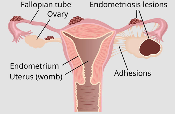 Why Botox Could Be A Secret Weapon Against Endometriosis, A Condition Affecting 10% Of Women
