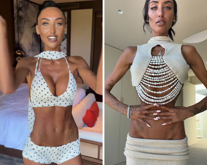 Influencer Gives Details On Bone-Breaking Plastic Surgery As Doctor Issues Urgent Warning Influencer Gives Details On Bone-Breaking Plastic Surgery As Doctor Issues Urgent Warning