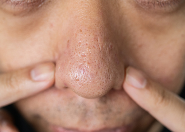 Dermatologist Warns Squeezing Black Spots On Your Nose Is A Serious Mistake Because They’re Not What You Think Dermatologist Warns Squeezing Black Spots On Your Nose Is A Serious Mistake Because They’re Not What You Think