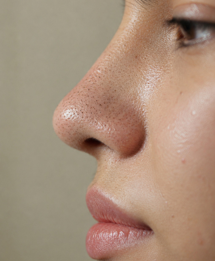 Dermatologist Warns Squeezing Black Spots On Your Nose Is A Serious Mistake Because They’re Not What You Think Dermatologist Warns Squeezing Black Spots On Your Nose Is A Serious Mistake Because They’re Not What You Think