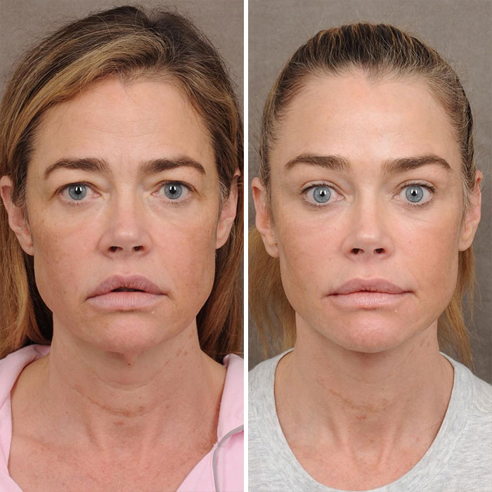 Denise Richards&rsquo; $200K Facelift Fuels &lsquo;The Substance&rsquo; Comparisons As Before-And-After Photos Go Viral