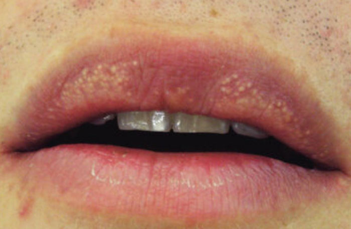 Doctors Urge Anyone With Clusters Of White Spots On Their Skin Or Intimate Areas Not To Ignore Them Doctors Urge Anyone With Clusters Of White Spots On Their Skin Or Intimate Areas Not To Ignore Them