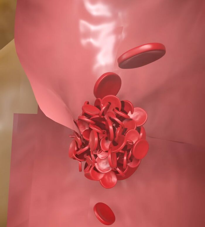 Doc Shares Graphic Simulation Of Neck Cracking, Revealing How A Simple Twist Could Lead To A Stroke Doc Shares Graphic Simulation Of Neck Cracking, Revealing How A Simple Twist Could Lead To A Stroke