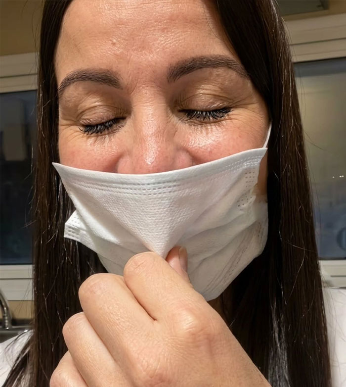 Woman Shares Shocking Lip Filler Results After A Cosmetic Injection Leaves Her In Tears