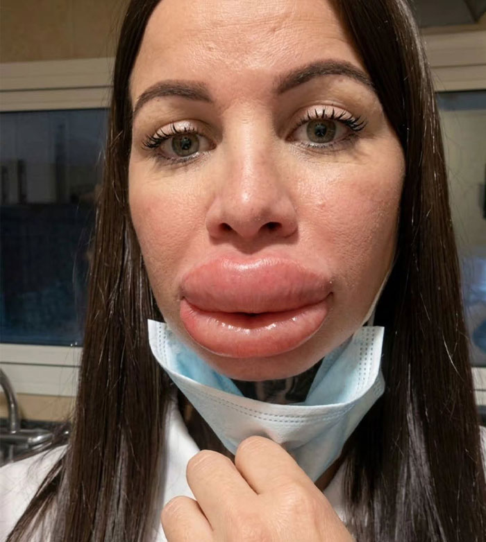 Woman Shares Shocking Lip Filler Results After A Cosmetic Injection Leaves Her In Tears